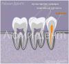 Como localizar e tratar canais dentais em Lumident