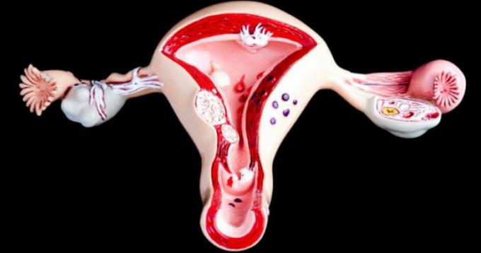 O câncer cervical - o cancro do colo do útero