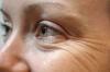 Como prevenir o aparecimento de rugas ao redor dos olhos