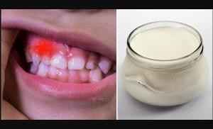 Como prevenir a cárie dentária e fortalecer o sistema imunológico