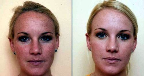Carbono da casca. Fotos antes e depois. O paciente tem o tipo de pele oleosa.