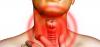 Tuberculose da laringe: os primeiros sinais de