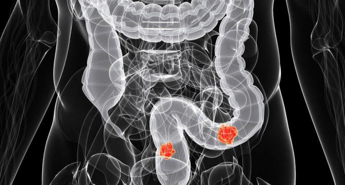 O cancro do intestino - câncer de cólon