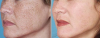 O melhor remédio para a pigmentação na face, pescoço e decote. O efeito é perceptível imediatamente após o primeiro uso