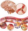 Aterosclerose cerebral: como tratar, quais são os sintomas?