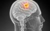 Os sintomas de tumor cerebral incipiente