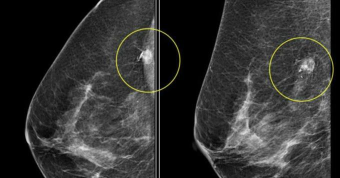 câncer de mama - o cancro da mama