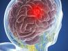 Tumor cerebral: 5 sintomas que não pode ser ignorado