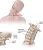 4 exercícios básicos para a coluna cervical vai ajudar a esquecer a dor e osteochondrosis!