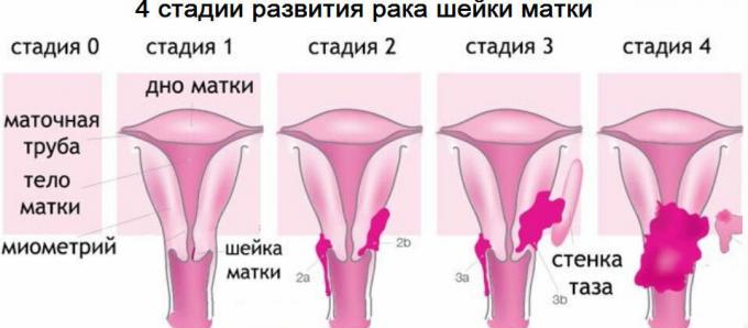 4 fases do cancro do colo do útero