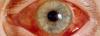 O glaucoma agudo: o que é, como tratar?