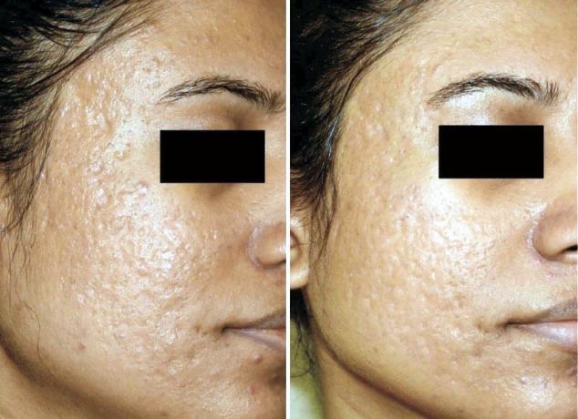 O resultado depois de dois tratamentos. a textura da pele tornou-se melhor e mostra. Com a pele tal que trabalhar muito duro