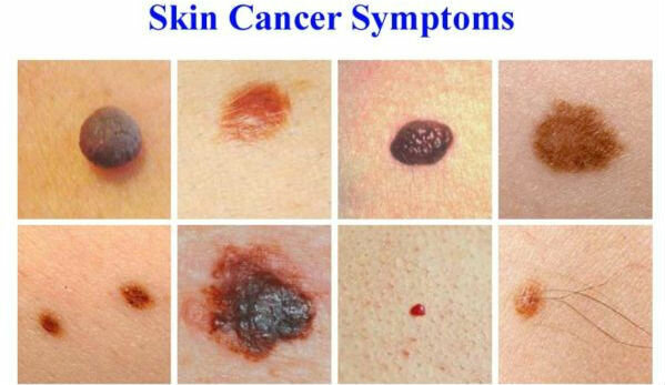 Os sintomas de câncer de pele