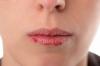 5 dicas sobre como evitar rachaduras dos lábios